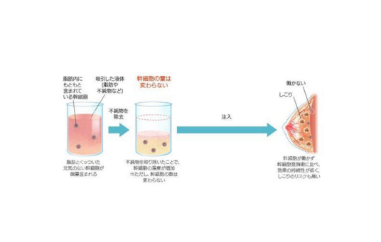 自体脂肪丰胸手术