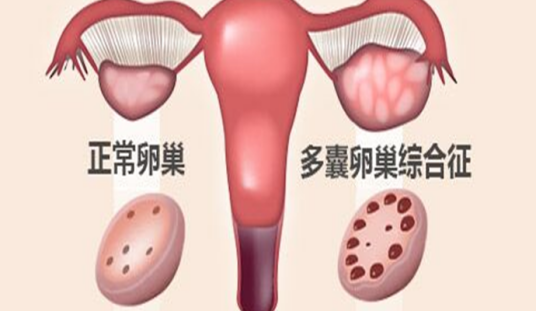 多囊性卵巢症候群