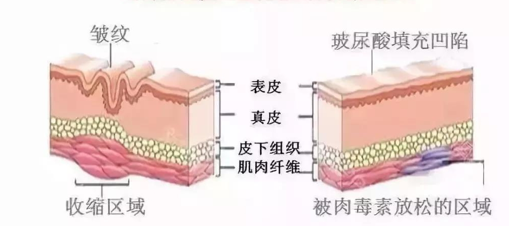 什么是amas全面部除皱