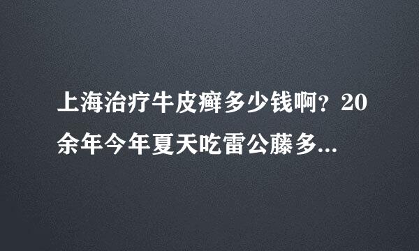 上海治疗牛皮癣多少钱啊？20余年今年夏天吃雷公藤多甙好转停药后现又明显加重