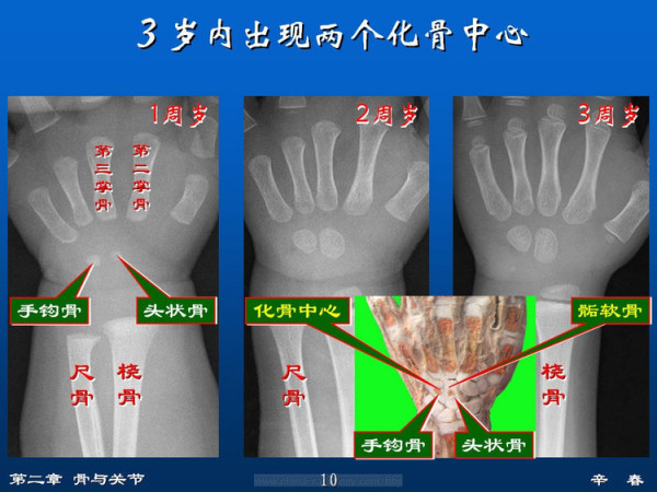 什么叫骨化