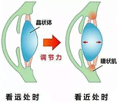 怎样治疗近视眼