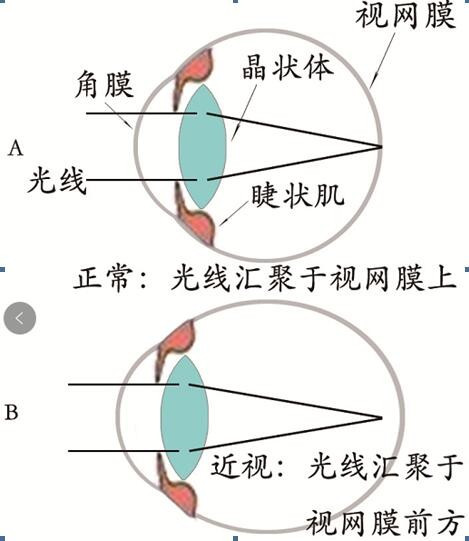 怎样治疗近视眼