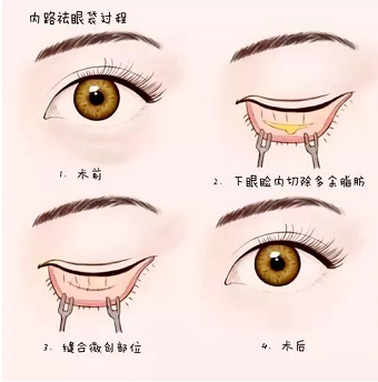 超声法去眼袋的价格是多少