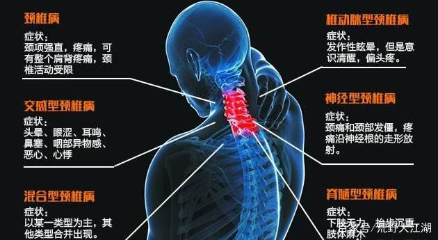 颈椎病能治好吗？