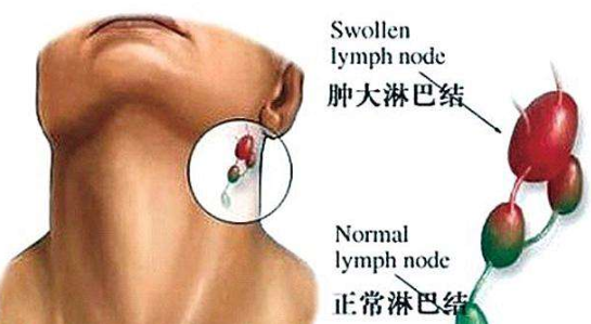 淋巴结是什么样子的