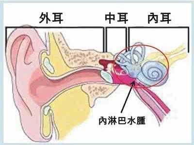 什么是梅尼埃综合征