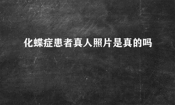 化蝶症患者真人照片是真的吗