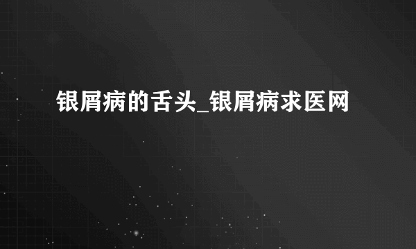 银屑病的舌头_银屑病求医网