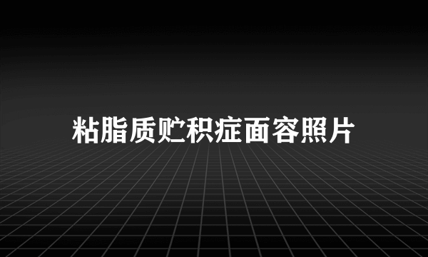 粘脂质贮积症面容照片