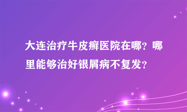 大连治疗牛皮癣医院在哪？哪里能够治好银屑病不复发？