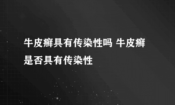 牛皮癣具有传染性吗 牛皮癣是否具有传染性