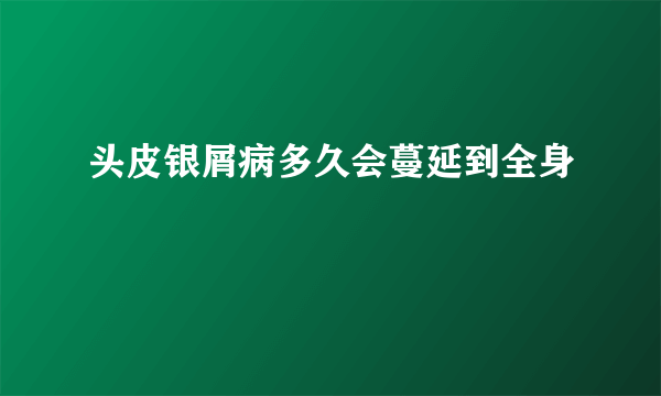 头皮银屑病多久会蔓延到全身