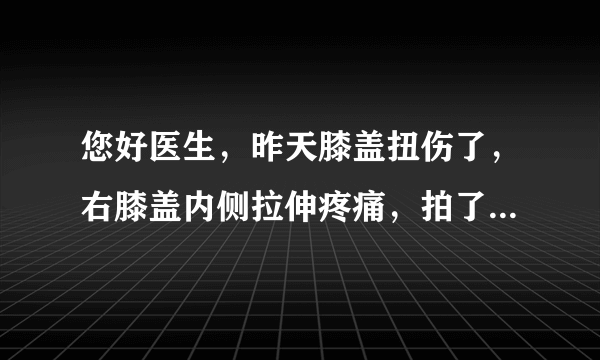 您好医生，昨天膝盖扭伤了，右膝盖内侧拉伸疼痛，拍了片子骨头没