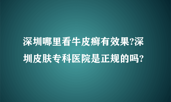 深圳哪里看牛皮癣有效果?深圳皮肤专科医院是正规的吗?